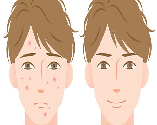 تفاوت انواع جوش صورت، علل ایجاد و راه درمان آن‌ها